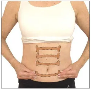 DIASTASIS RECTI TOGETHER TAPE™ (WHOLESALE)