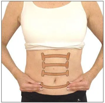 DIASTASIS RECTI TOGETHER TAPE™ (WHOLESALE)